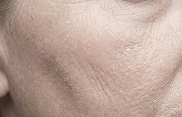 Fototapeta premium Extreme close-up of mature, aging skin on a face showing extreme dryness, fine flaking, crepey texture, and prominent wrinkles.