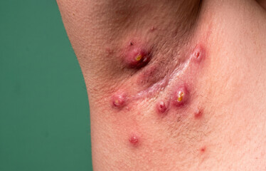 Fototapeta premium Severe hidradenitis suppurativa abscesses and chronic scarring in the axilla underarm region of patient
