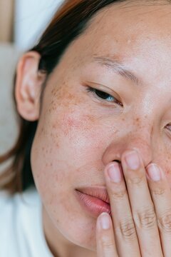 Close up of a woman with freckles and dry skin texture touching her face, showing visible pores and skin irritation for dermatology advertising