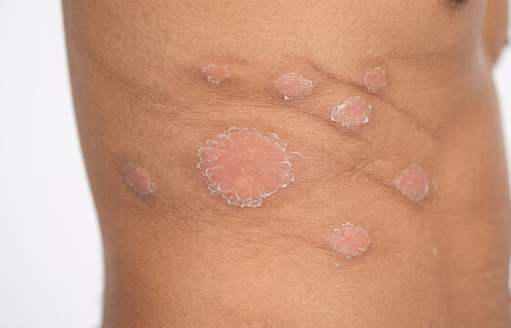 Close up of scaly red circular plaques of nummular eczema or psoriasis on side torso