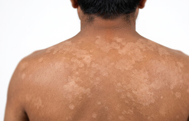 Naklejka premium Back view of extensive tinea versicolor fungal infection patches on dark skin male torso