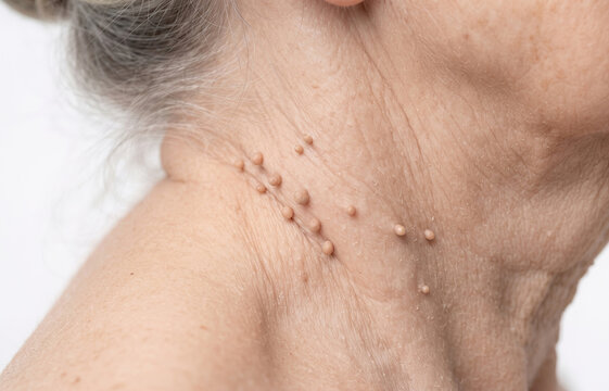 Close up view of multiple acrochordons skin tags on senior female neck skin