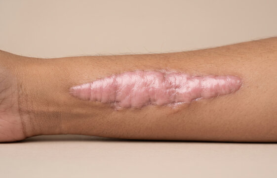 Close up of a large raised hypertrophic surgical scar on male forearm skin