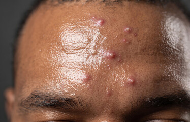 Fototapeta premium Macro view of oily forehead with severe acne vulgaris pustules and pimples on dark skin
