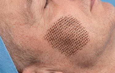 Naklejka premium Close up of fractional laser resurfacing grid marks and micro scabs on patient cheek