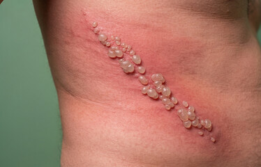 Fototapeta premium Close up of painful shingles herpes zoster blisters and fluid filled vesicles on human torso