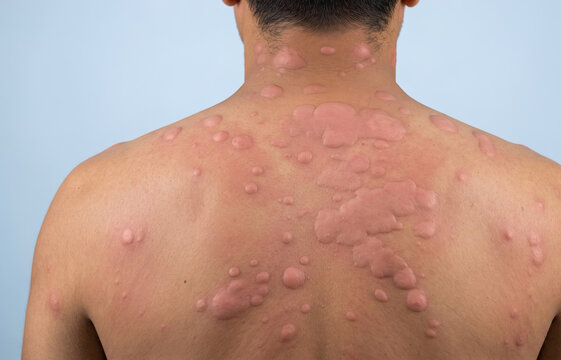 Back view of severe urticaria hives rash and itchy raised wheals on male skin