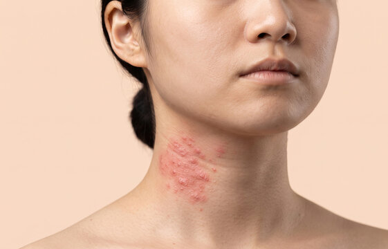 Close up of painful shingles herpes zoster rash and skin inflammation on female neck