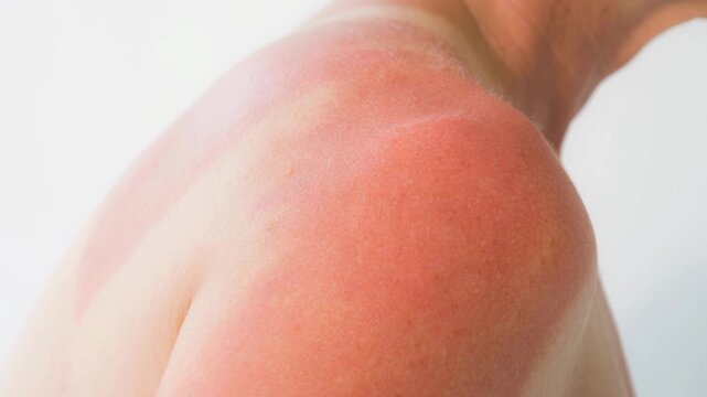 Close up of human shoulder with red sunburn skin damage on light background