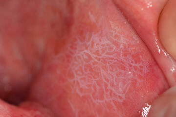 Fototapeta premium Oral Lichen Planus With Characteristic Wickham Striae on Buccal Mucosa