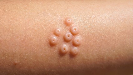 Fototapeta premium Clinical close-up of molluscum contagiosum papules on human skin
