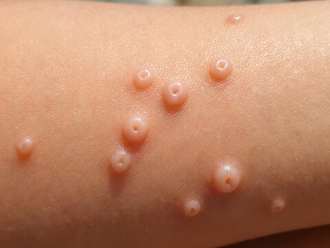 Molluscum contagiosum lesions on human skin, clinical dermatology close-up