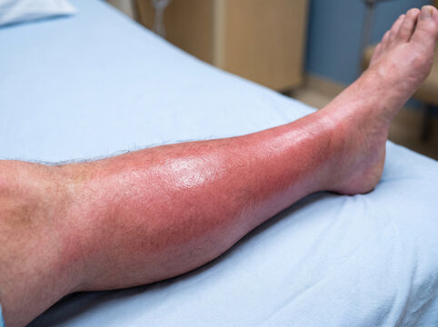 Bacterial Cellulitis Spreading Hot Red Swelling on Adult Lower Leg with Marked Border, Skin Infection Medical Stock Photograph