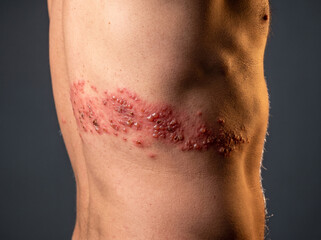 Fototapeta premium Herpes Zoster Shingles Painful Vesicular Rash Following Dermatome Band on Adult Flank, Skin Disease Medical Reference Image