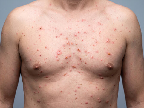 Chickenpox Varicella Rash with Vesicles Papules and Crusts at Different Stages on Adult Torso,  Skin Disease Photograph