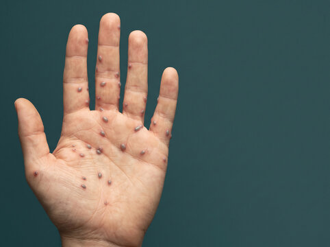 Hand Foot and Mouth Disease Small Oval Vesicles on Adult Palm and Fingers, Coxsackievirus Skin Infection Macro Medical Image