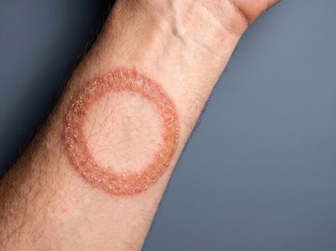 Tinea Corporis Ringworm Annular Lesion with Raised Scaly Border on Adult Forearm, Fungal Skin Infection Macro Medical Photograph