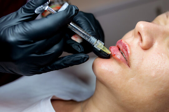 Professional lip filler injection procedure performed by an aesthetic specialist. Close-up of cosmetic treatment for lip enhancement and facial aesthetics.