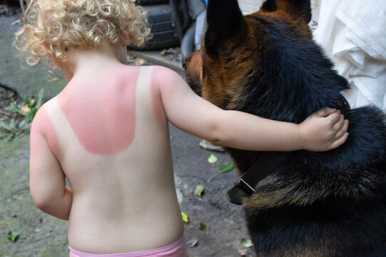 Child with sunburn hugging dog outdoors close up. Painful red skin sunburn on toddler back after sun uv damage for summer pediatric dermatology and sun protection concept.