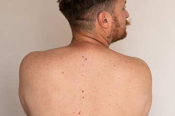 Naklejka premium Close-up of a man's back with multiple moles and freckles for dermatology, skin cancer screening, melanoma awareness, mole monitoring, and preventive healthcare.