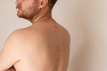 Naklejka premium Close-up of a man's back with multiple moles and freckles for dermatology, skin cancer screening, melanoma awareness, mole monitoring, and preventive healthcare.