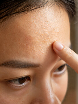 Close-Up of Closed Comedones and Bumpy Skin on Forehead