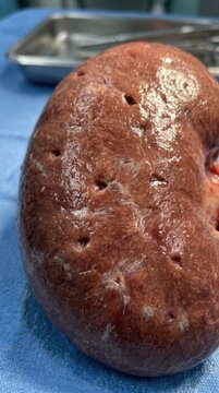 Human kidney cortex, cocaine induced renal ischemia showing pitted surface with pale scarring, depressed microscopic infarctions from chronic vasoconstriction, vascular pathology of substance abuse.