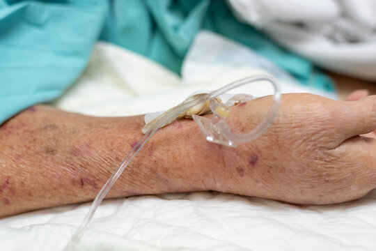 Close up of an elderly patient hand intravenous cannula medical tubing during hospital treatment showing healthcare nursing infusion therapy patient care