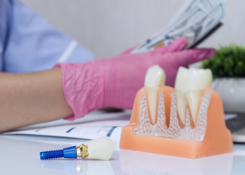 Expensive dental treatment concept showing artificial tooth implant on table and doctor holding cash dollars in background.