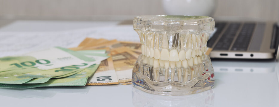 Financial investment in expensive dentistry. Educational tooth model showing implant placement next to euro cash.