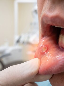 Close-up of a Patient's Lower Lip with a Canker Sore Being Examined by a Healthcare Professional in White Gloves