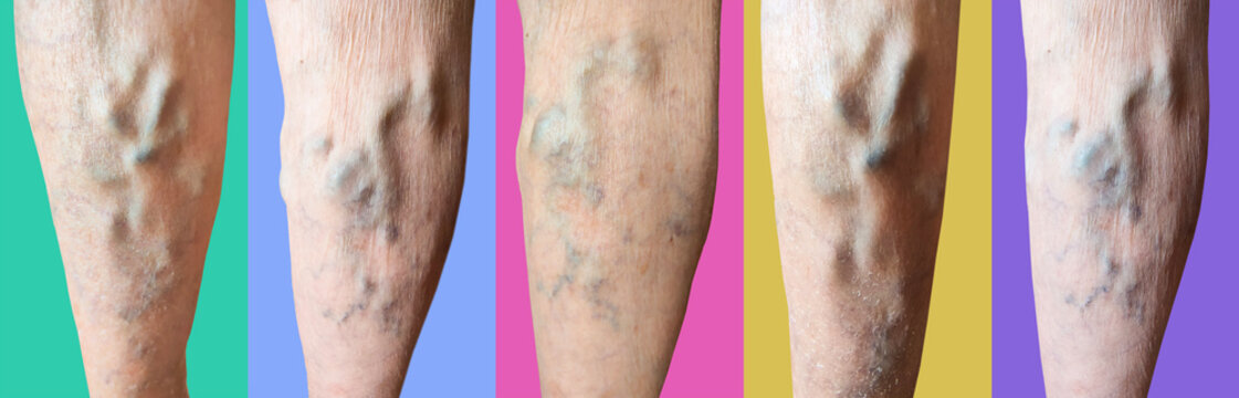The varicose veins on a legs of old woman closeup