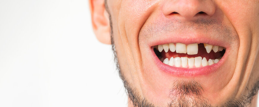 male smile with a missing upper front tooth removed. Dental surgery and dental implantation. Dental problems. Portrait of a adult man without a tooth on a white isolated background