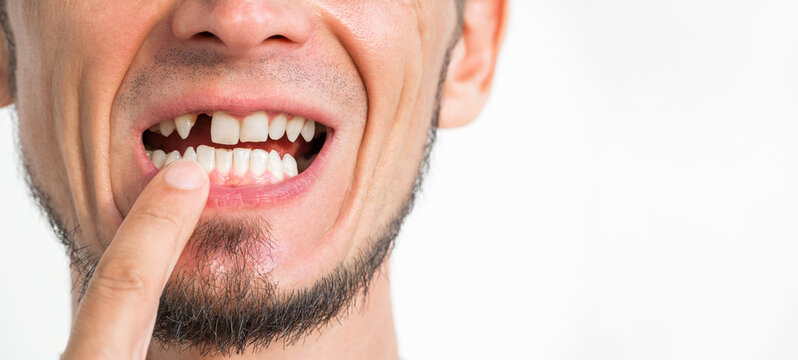 Portrait of a man with missing tooth. Dental surgery and implantation. The upper front tooth was removed. Dental problems