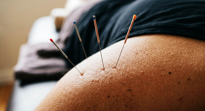 Acupuncture Needles in Upper Back and Shoulder During Holistic Therapy Treatment