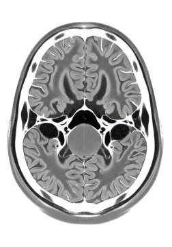 A brain scan showing the cerebral cortex and other brain structures