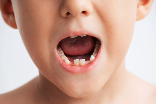 Close-up portrait of a young child with missing baby tooth during natural tooth loss and dental development. Concept of children's oral health, primary teeth, permanent teeth, pediatric dentistry