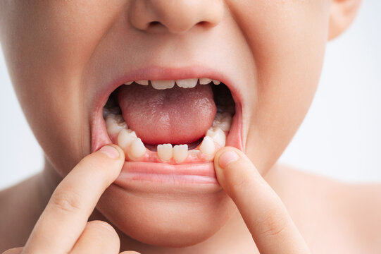 Young child showing a missing milk tooth in close-up portrait, representing children's dental health, oral care, tooth development and pediatric dentistry