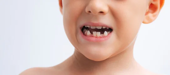 portrait of a child with lost baby teeth. Replacement of baby teeth with permanent ones. Concept of pediatric dentistry on white isolated background. Baby's mouth without front lower teeth close-up © alexkoral