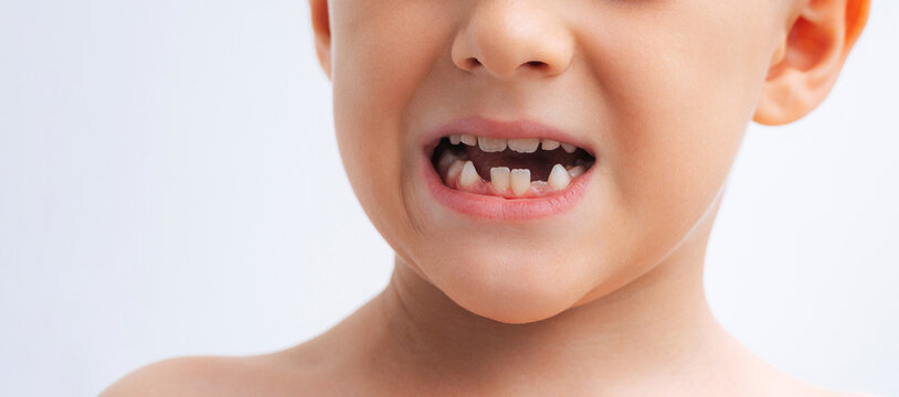 portrait of a child with lost baby teeth. Replacement of baby teeth with permanent ones. Concept of pediatric dentistry on white isolated background. Baby's mouth without front lower teeth close-up