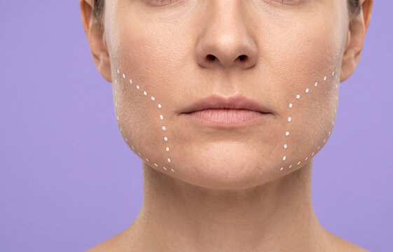 Close up of woman chin and jawline with white surgical dotted lines for plastic surgery contouring