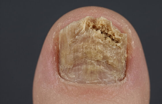 Extreme macro close-up of a toenail suffering from severe onychomycosis, showing thick, brittle, and discolored fungal nail infection.