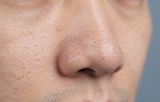 Extreme close up of enlarged pores and dense blackheads comedones on human nose