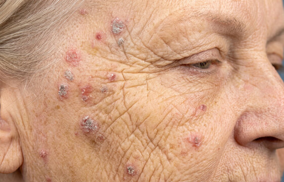 Macro view of multiple actinic keratosis skin lesions and sun damage on senior female face