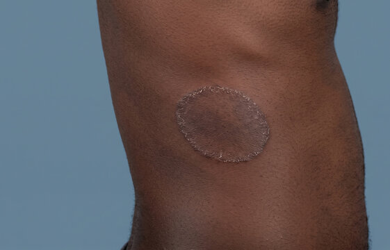 Close up of a large classic ringworm tinea corporis fungal infection on dark skin torso