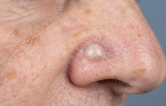 Close up of a pearly basal cell carcinoma skin cancer nodule on human nose