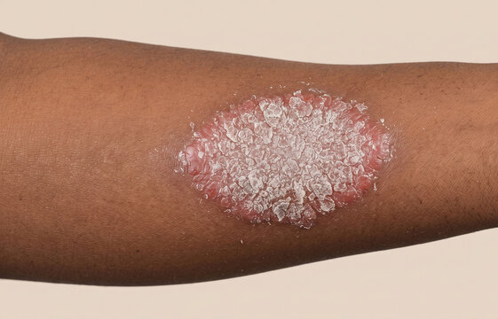Close up of a large ringworm tinea corporis fungal infection on dark skin arm