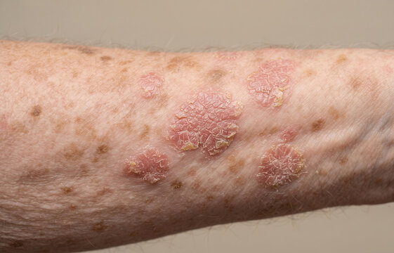 Close up of multiple actinic keratosis skin lesions on sun damaged senior arm