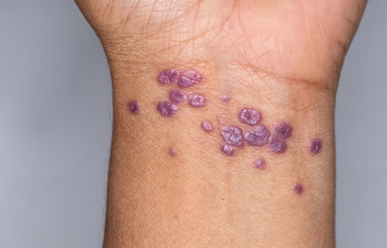 Close Up View of Lichen Planus Purple Papules and Eruption on Inner Wrist Skin