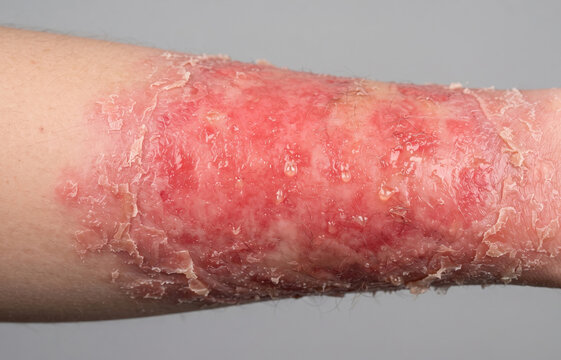 Close Up of Severe Skin Burn with Blisters and Peeling Skin on Forearm